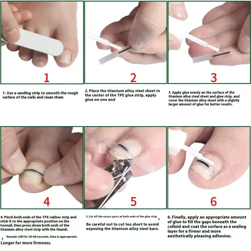 5pcs Ingrown Toenail Correction Tool Ingrown Toe Nail Treatment Elastic Patch Sticker Straightening Clip Brace Pedicure Tool