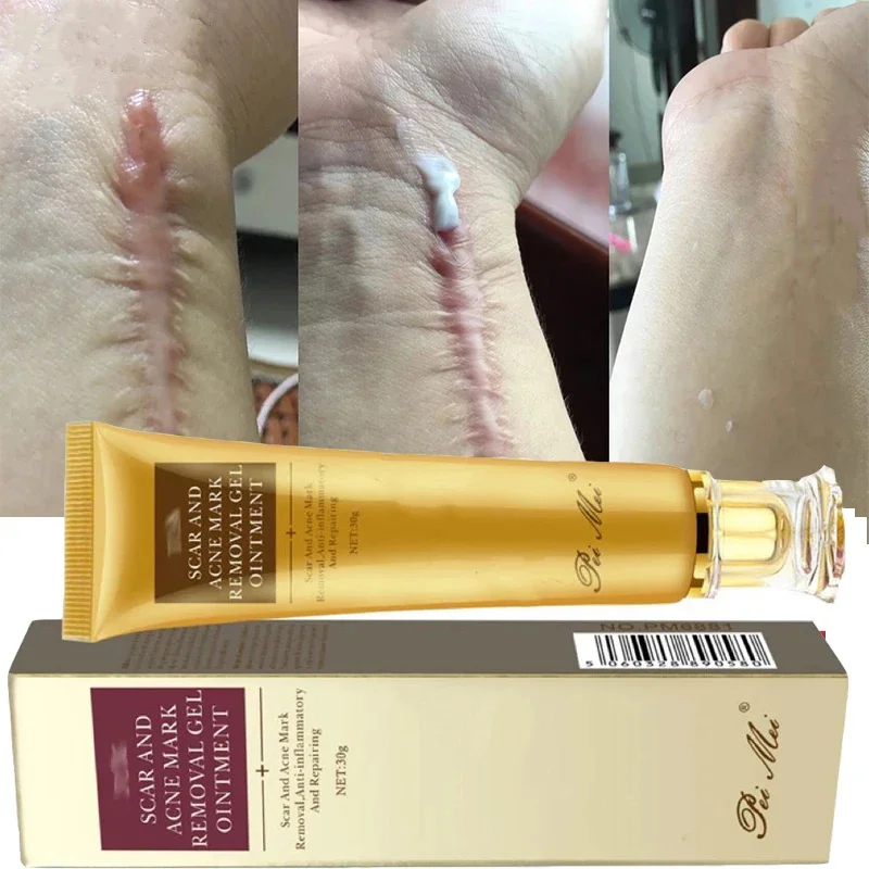 Fast Scar Removal Cream Treatment Stretch Marks Burn Surgical Scars Acne Spot Repair Whiten Moisturizing Skin Care Beauty Health