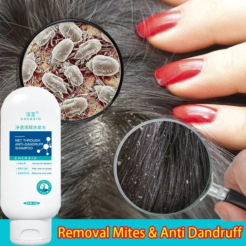 1pcs Dandruff Shampoo Lice Mites Remover Shampoo Scalp Follicle Dissolve Oil Antipruritic Anti Hair Loss Treatment