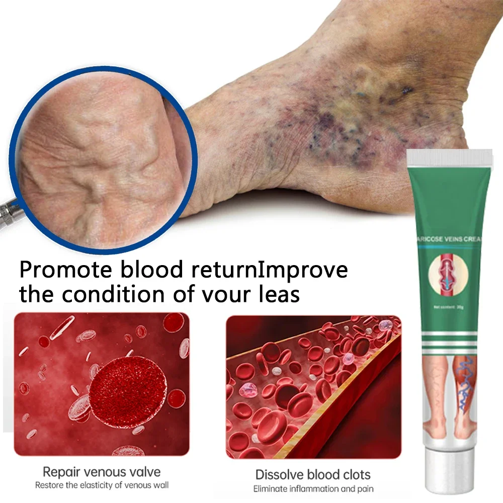 Spider blood vessels varicose veins Effective varicose vein relief cream to relieve vasculitis phlebitis spider pain treatment