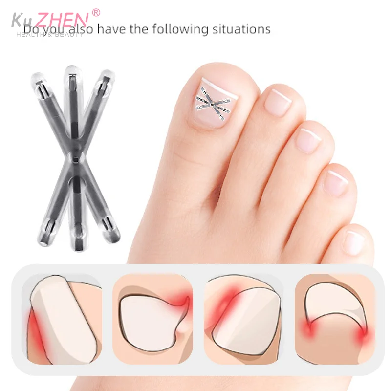 2Pc 13/17MM Ingrown Toenail Correction Tool Ingrown Toenail Treatments Elastic Patch Sticker Toenail Straightening Pedicure Tool
