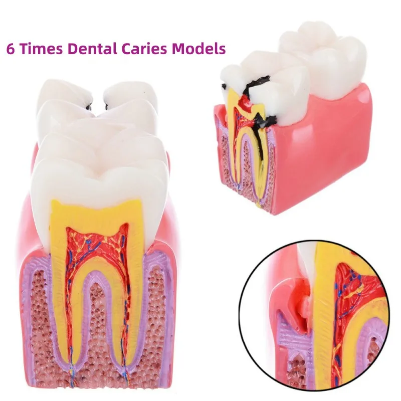 6 Times Dental Caries Comparsion Models Dental Teaching Model For Dental Study Teaching Dental Anatomy Endodontics Education