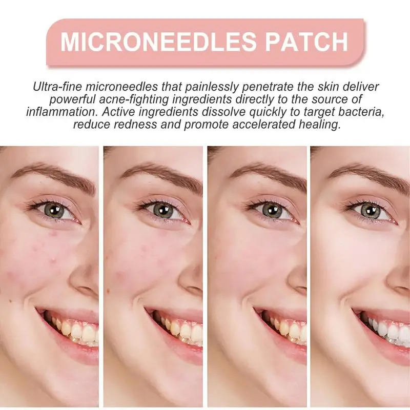 Parches de puntos faciales con microagujas, parche hidrocoloide de 72 puntos, pegatinas para manchas de espinillas y cubierta de Zits