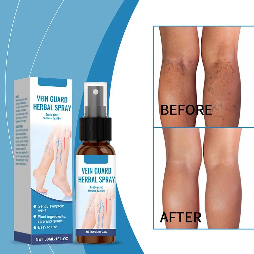 30 мл Специальный уход за варикозным расширением вен, спрей, медицинское расширение вен, измельченная нога, зеленые мышцы, выпуклость, земляной червь, нога K9X3 30 мл Специальный уход за варикозным расширением вен, спрей, медицинское расширение вен, измельченная нога, зеленые мышцы, выпуклость, земляной червь, нога K9X3