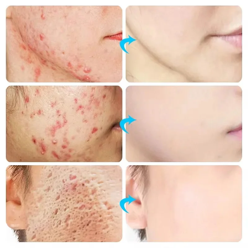 Acne Cream For Face Pimples Remover Treatment Shrink Pores Oil Control Lighten Acne Marks Whitening Smoothing Facial Skin Care view 2
