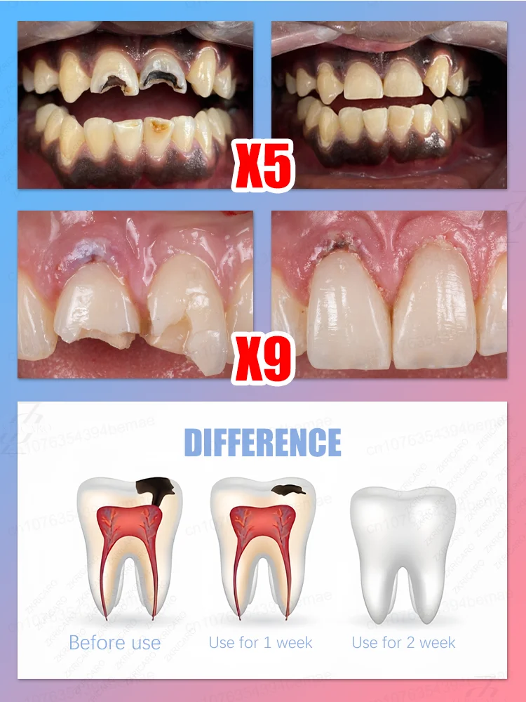 معجون أسنان لتبييض الأسنان - تركيبة إنزيم، إزالة البقع، التنظيف العميق، نفس منعش، شحن مجاني