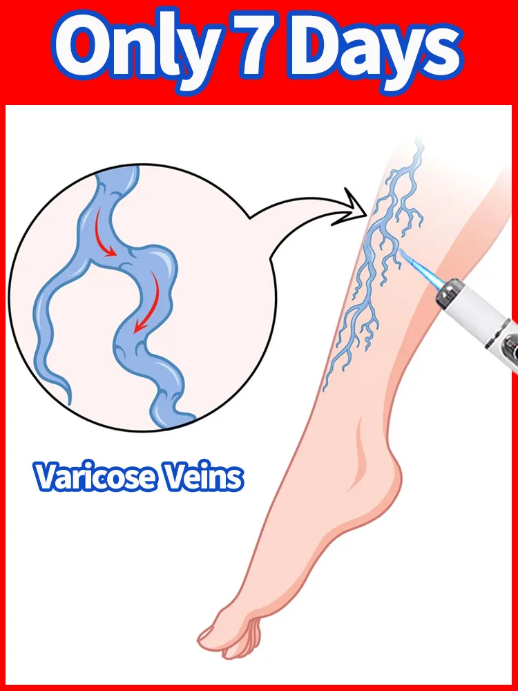 

Hot Sale Varicose Vein Pen Laser For Varicose Veins Effective Treatment Painless