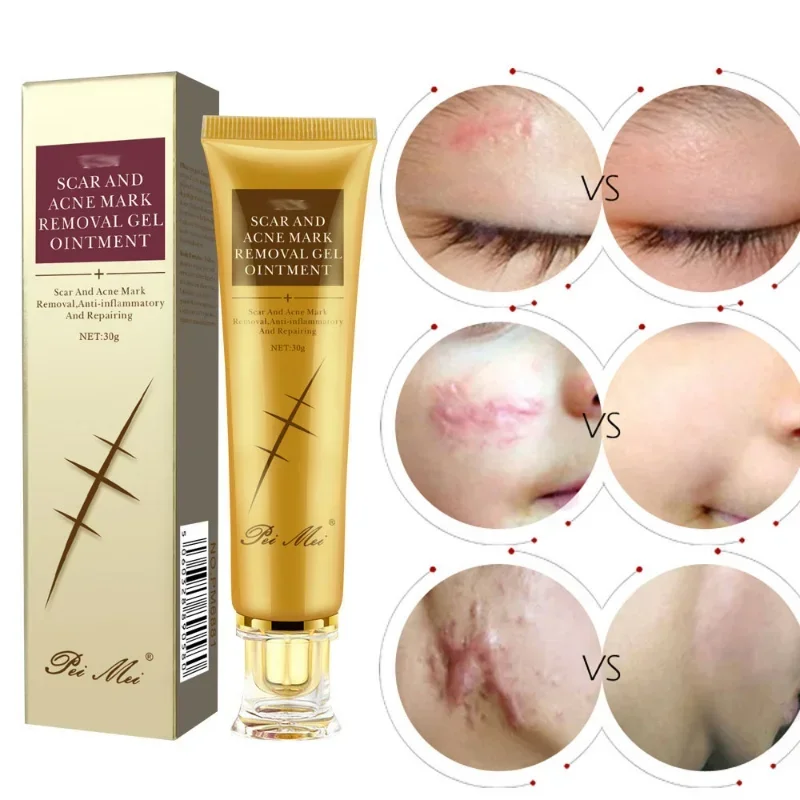 Skin Scar Removal Cream Face Repair Fade Scars Acne Spots Treatment Blackhead Whitening ointment Anti Scar Stretch Marks Beauty