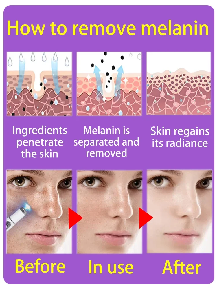 Freckles Melasma Melasma Dark Spots on Face Blu-ray pen