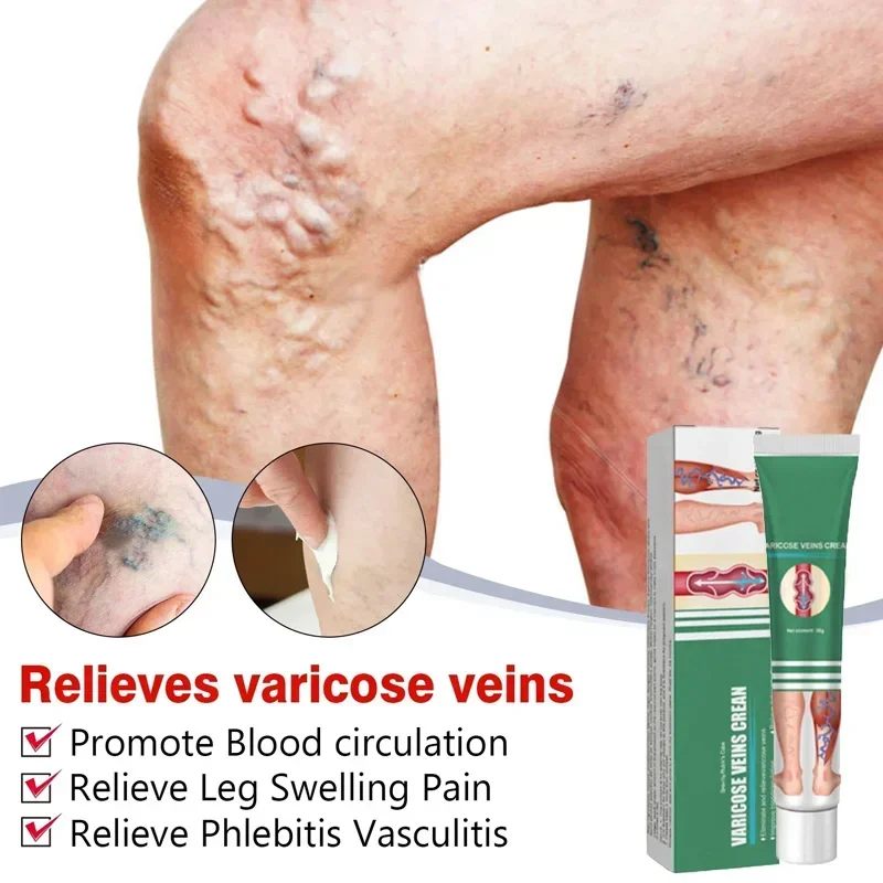 Tratamiento de venas varicosas eficaz ingrediente Natural alivio de venas varicosas, tratamiento del dolor de araña, Vasculitis flebitis