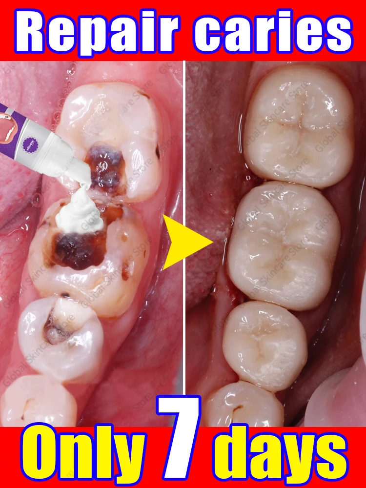 Risolve il problema delle carie e della carie dei denti