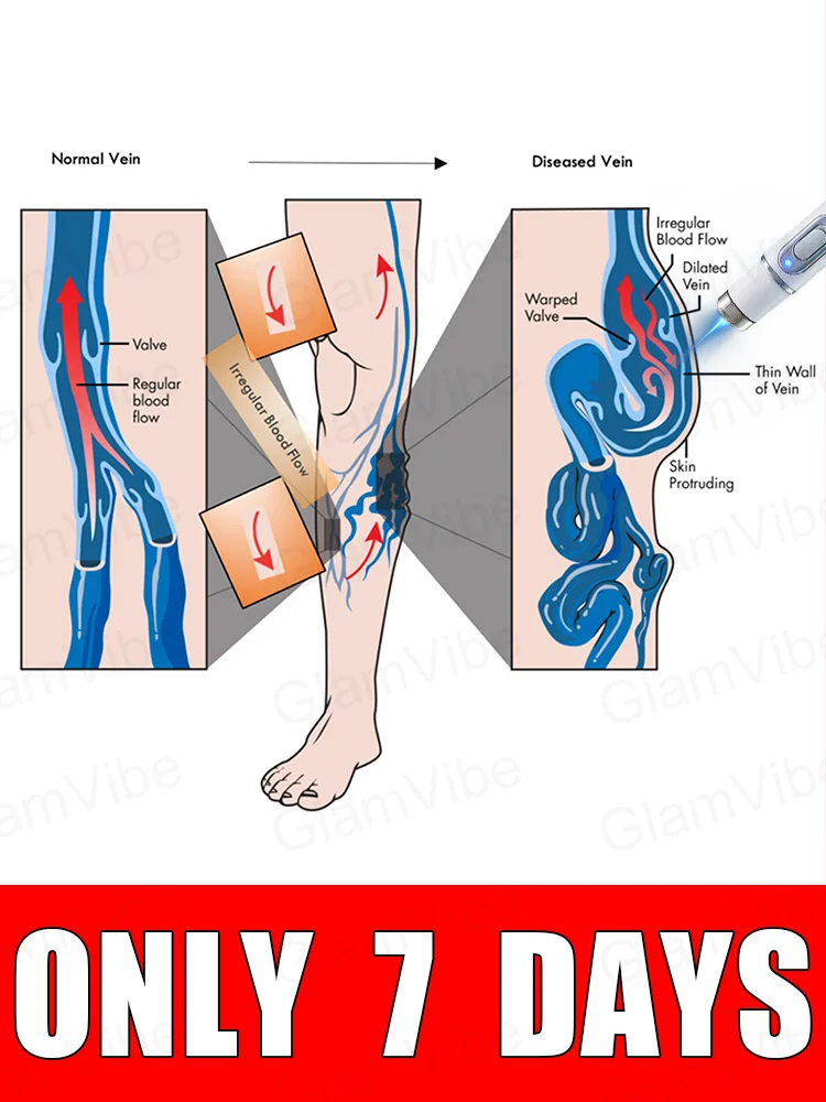 

Leg care tools, blue light pen, varicose veins, 2025 hot sale