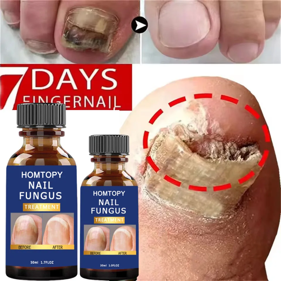 เซรั่มรักษาเชื้อราเล็บเท้า กำจัดเชื้อราที่เล็บนิ้วเท้า น้ำมันหอมระเหยป้องกันการติดเชื้อโรค โรคเล็บอักเสบ โรคเล็บอักเสบชนิดอักเสบบริเวณเล็บ บำรุงและฟื้นฟู
