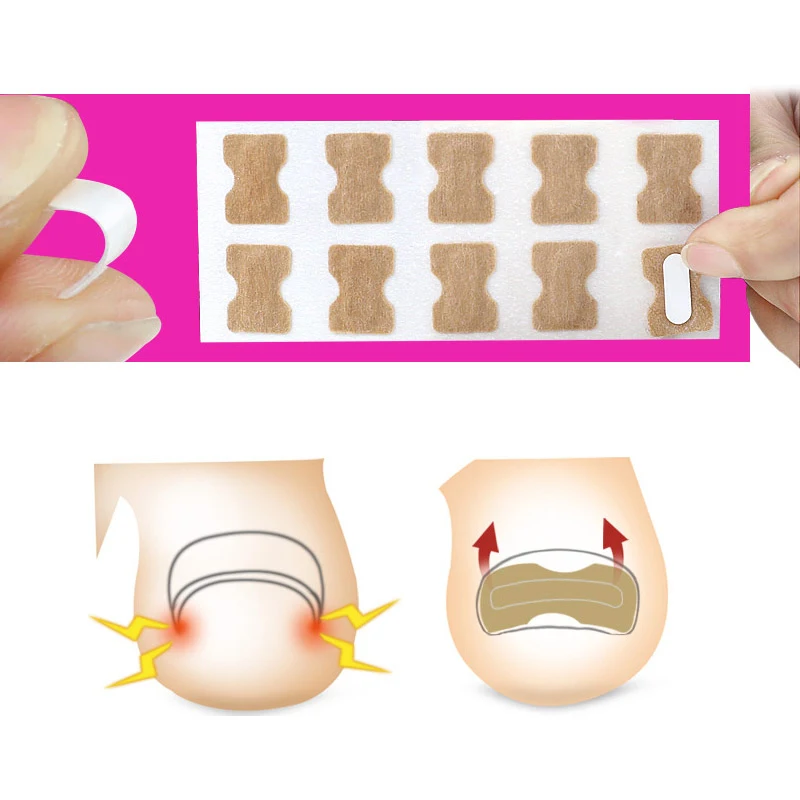 Pexmen 100/200/500/1000Pcs Ingrown Toenail Treatment No Glue Breathable Corrector Patch Painless ingrown toenail corrector