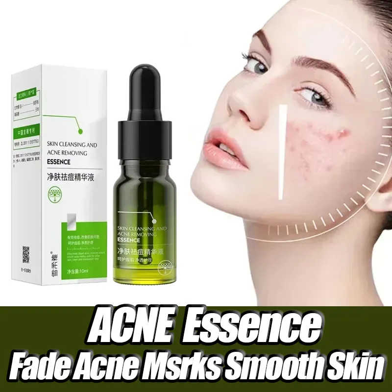 Effective Acne Removal Comfortable Acne-removing Liquid Improve Acne Convenient Facial Repair Solution Skin Care Products Gentle