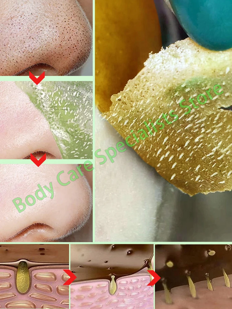 

Blackhead Skin Care