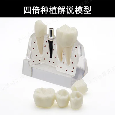 Dental Teaching Model of Dental Caries Decomposition Model Oral Dental Tooth Model Teeth Whitening  Teaching decoration