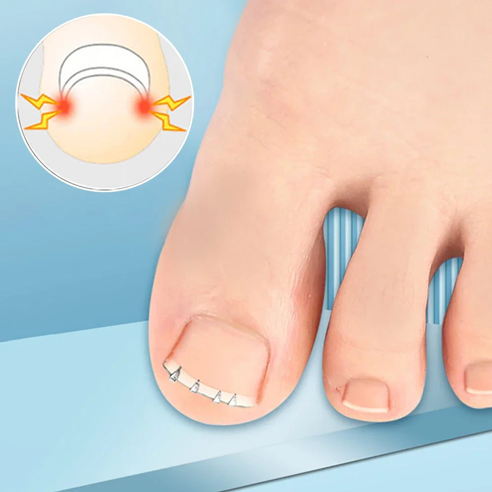 Ingrown Toenail correção ferramenta para dedos dos pés, Foot Care, curvo braçadeira, pedicure ferramenta