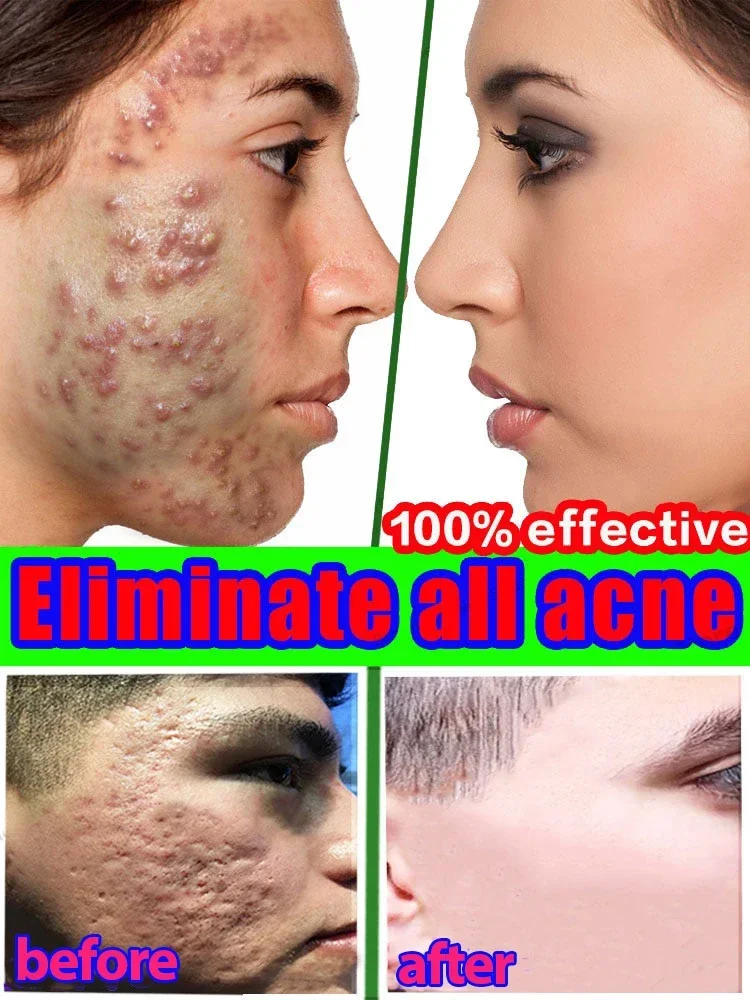 Ervas-acne tratamento rosto soro, espinhas removedor, encolher poros, controle de óleo, cuidados com a pele