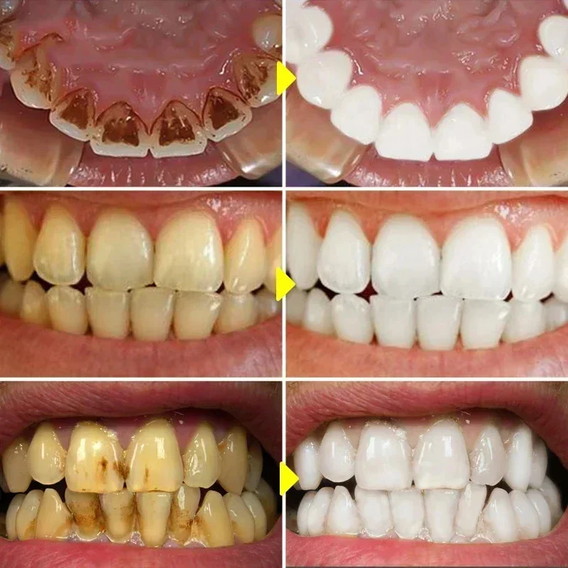 Usuń plamy z płytki nazębnej Wybielanie zębów Pasta do zębów Kwas owocowy Świeży oddech Czyszczenie Higiena jamy ustnej Wybielacz dentystyczny Narzędzie do pielęgnacji