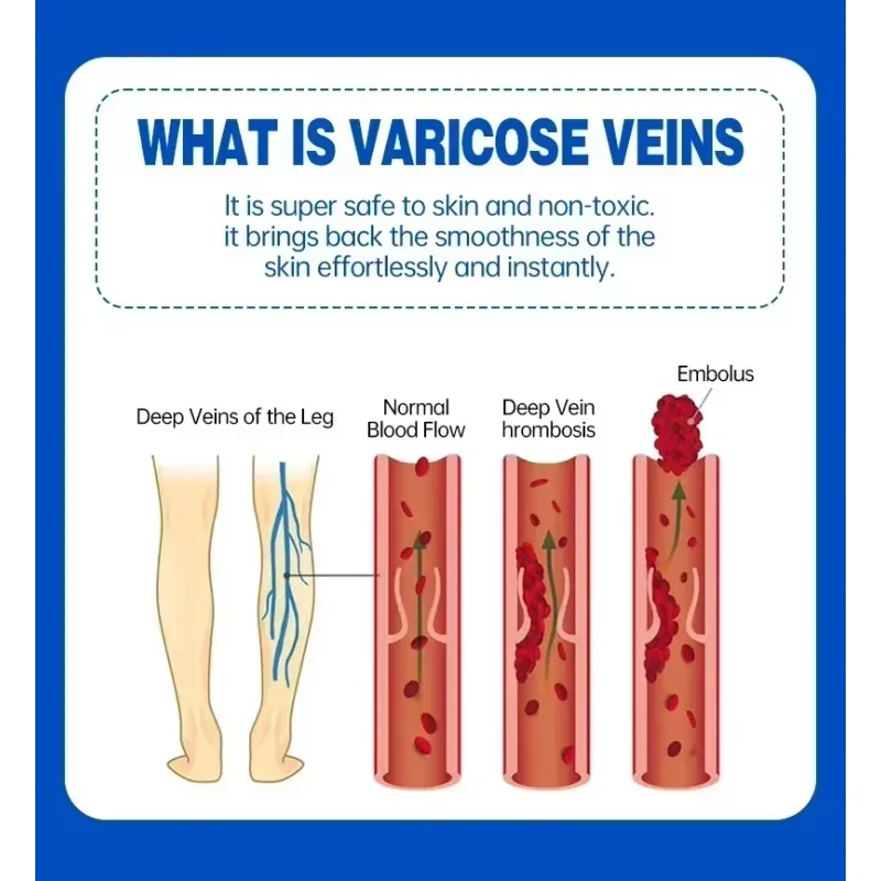 Effective Relieve Varicose Vein Ointment Get rid of Spider Legs Vasculitis Phlebitis Cream