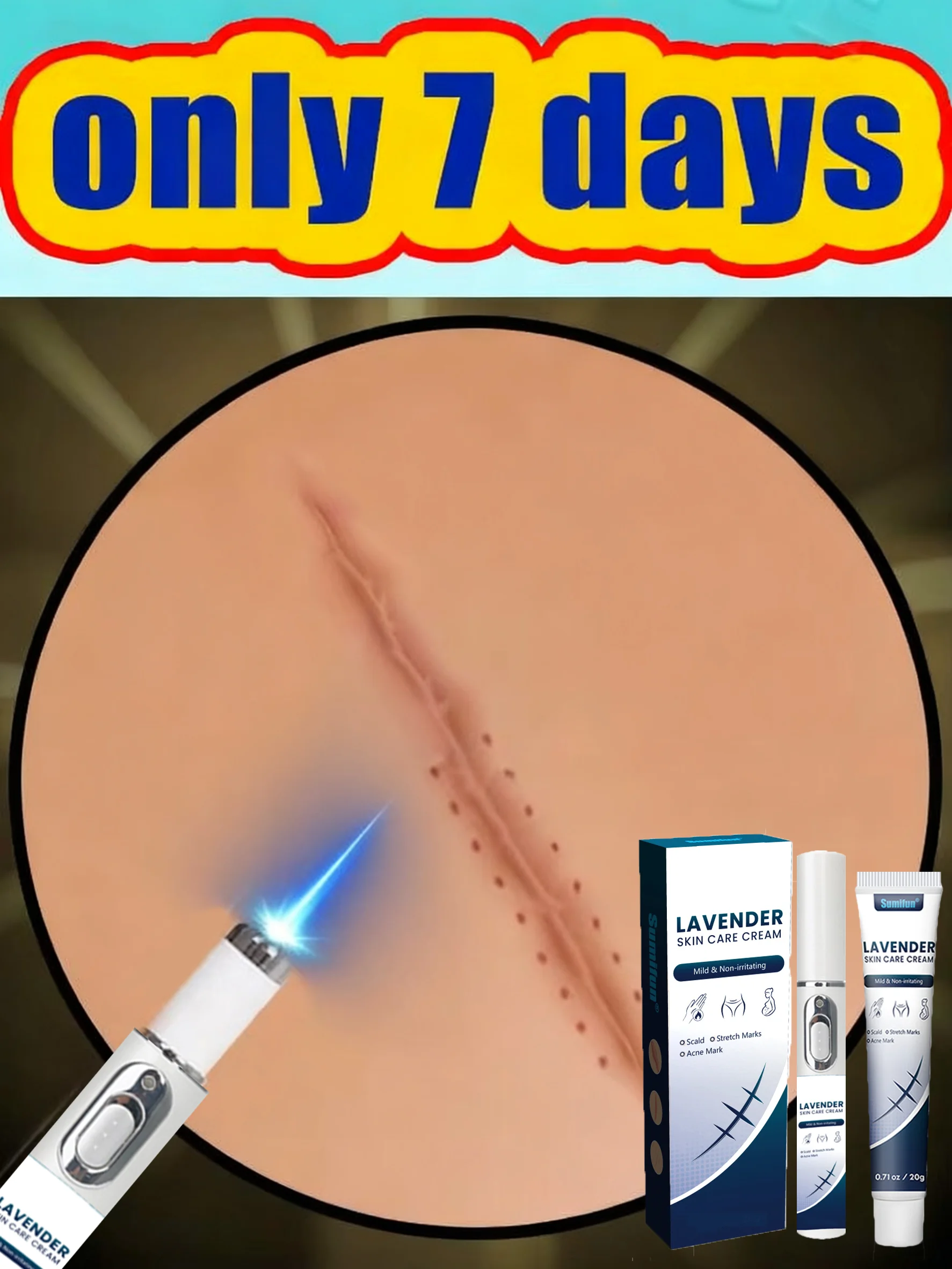 

Laser Pen for Post-Pregnancy Stretch Marks: Visible Improvement in Weeks