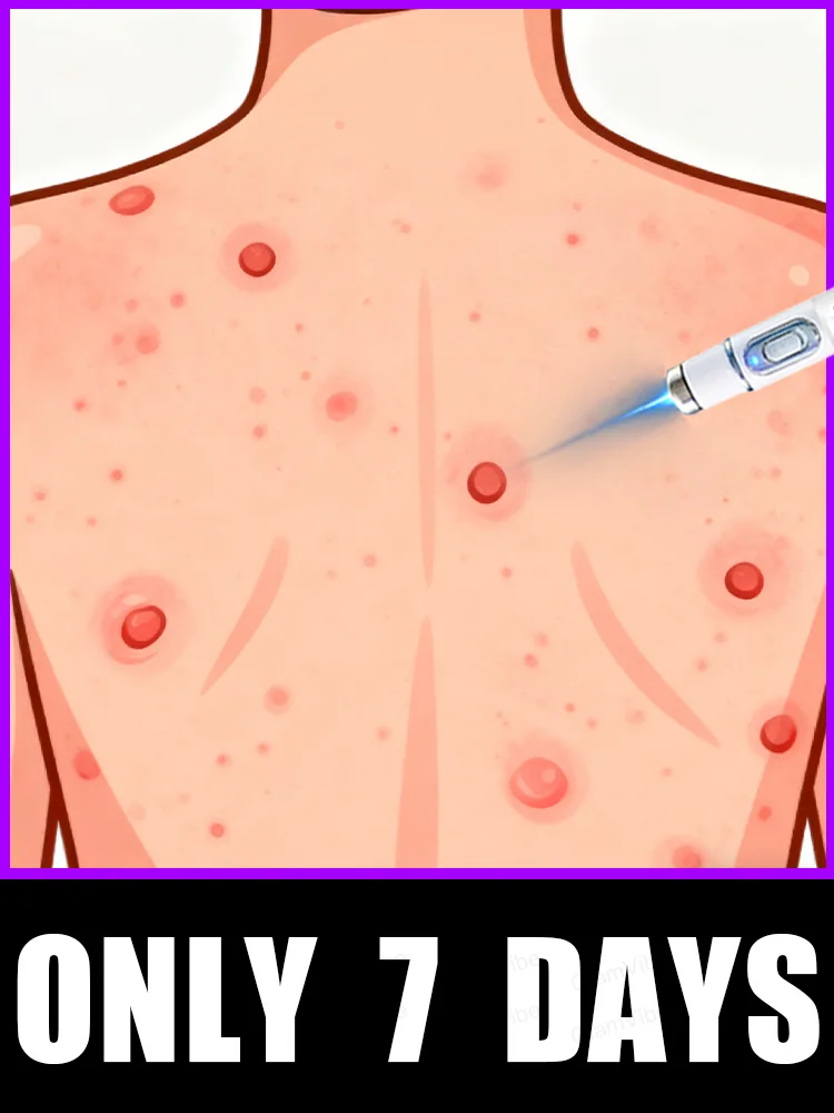 

2025 New Upgrade Blue Laser Solve Wart Tool