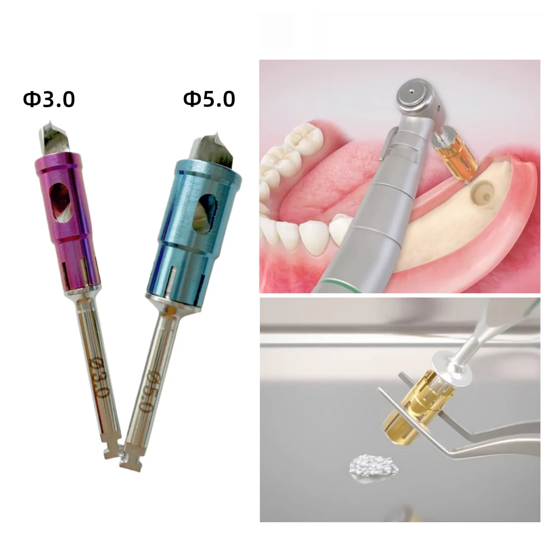 

Dental Never Loss Bone Collector Drills Implant Stopper Self Bone Powder Harvest 3.0/5.0mm