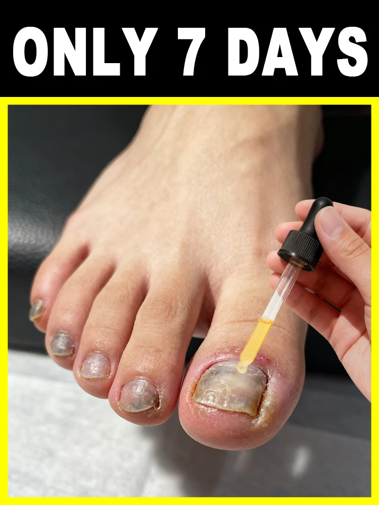 

This nail spray can not only remove bacteria and gray nails, ᵇᵘᵗ ᵃˡˢᵒ ᶠᵒʳᵐ ᵃ ᵖʳᵒᵗᵉᶜᵗⁱᵛᵉ ˡᵃʸᵉʳ