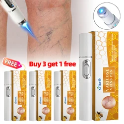 4Pcs Varicose Veins Laser Therapy Pen Improves Moderate Varicose Vein For Men Women Relieve Leg Pain Improve Blood Circulation