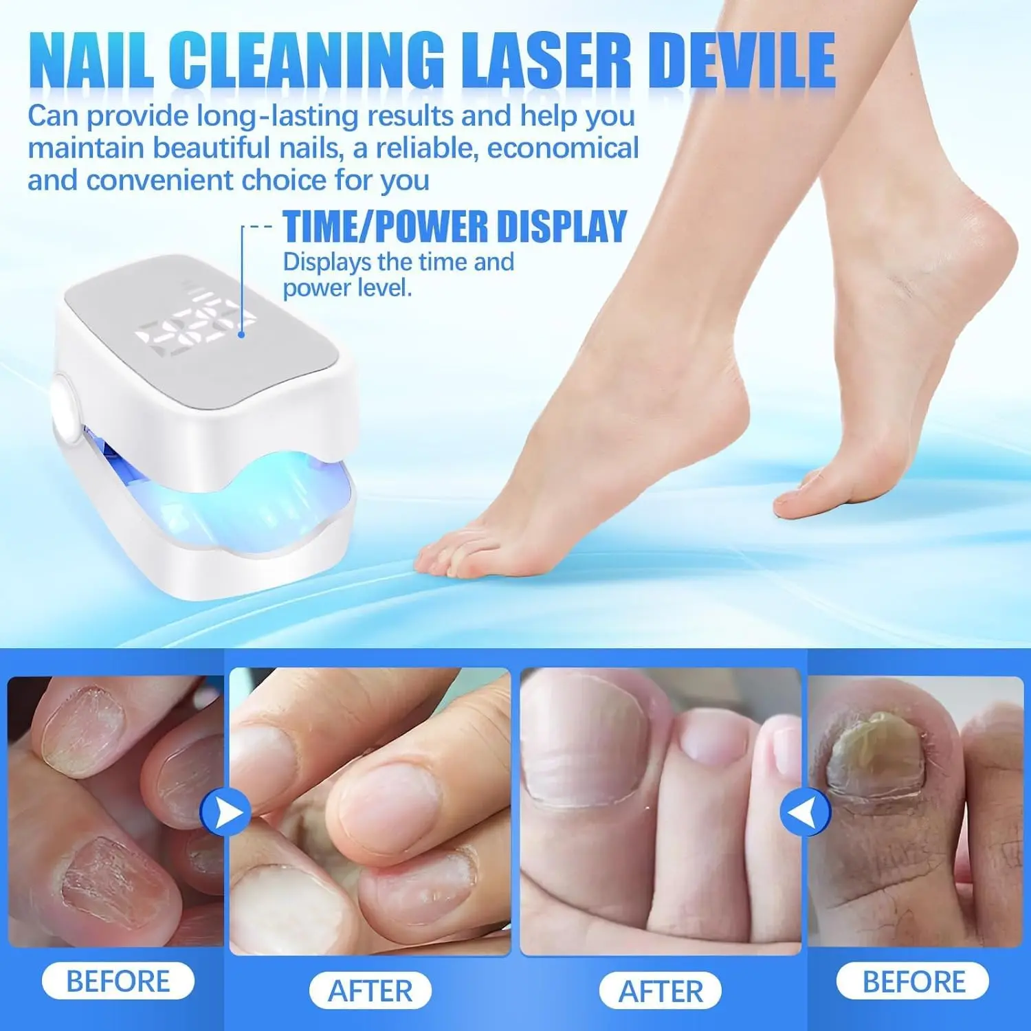 Nail Fungus Laser Device with Time Display 470nm950nm wavelength Fast-acting Home Anti Fungal Laser Device for Finger/Toenails