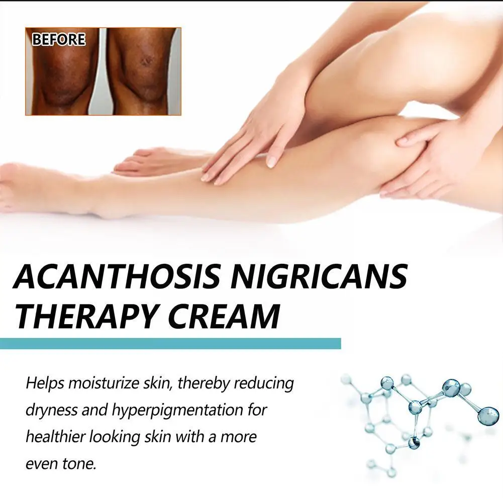 EELHOE Acanthosis Nigricans Therapy Cream Cream for Underarm Arm Knee Joint Black Moisturizing and Whitening Body Care Cream