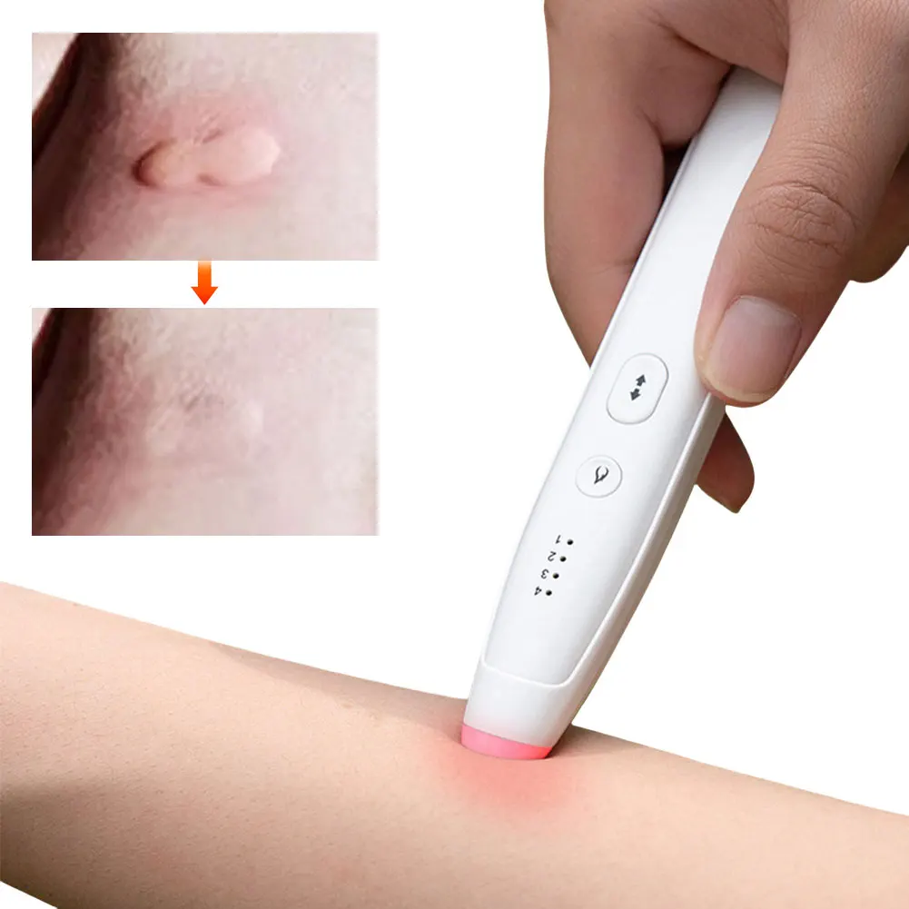 携帯型のかゆみ止めペン、充電式虫刺されかゆみ緩和ペン、蚊刺され熱ペン、かゆみや腫れの症状を和らげるためのもの