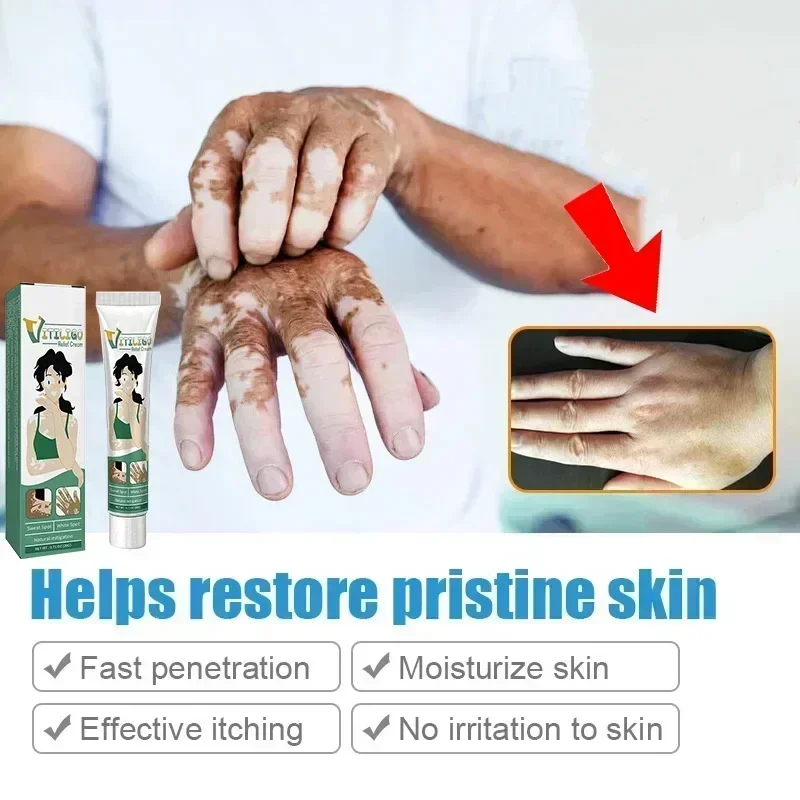 NewWhite Spot Cream for Vitiligo White Spots Leukoplakia Pigmentation Melanin Promoting Vitiligo Cream Skin Care0903