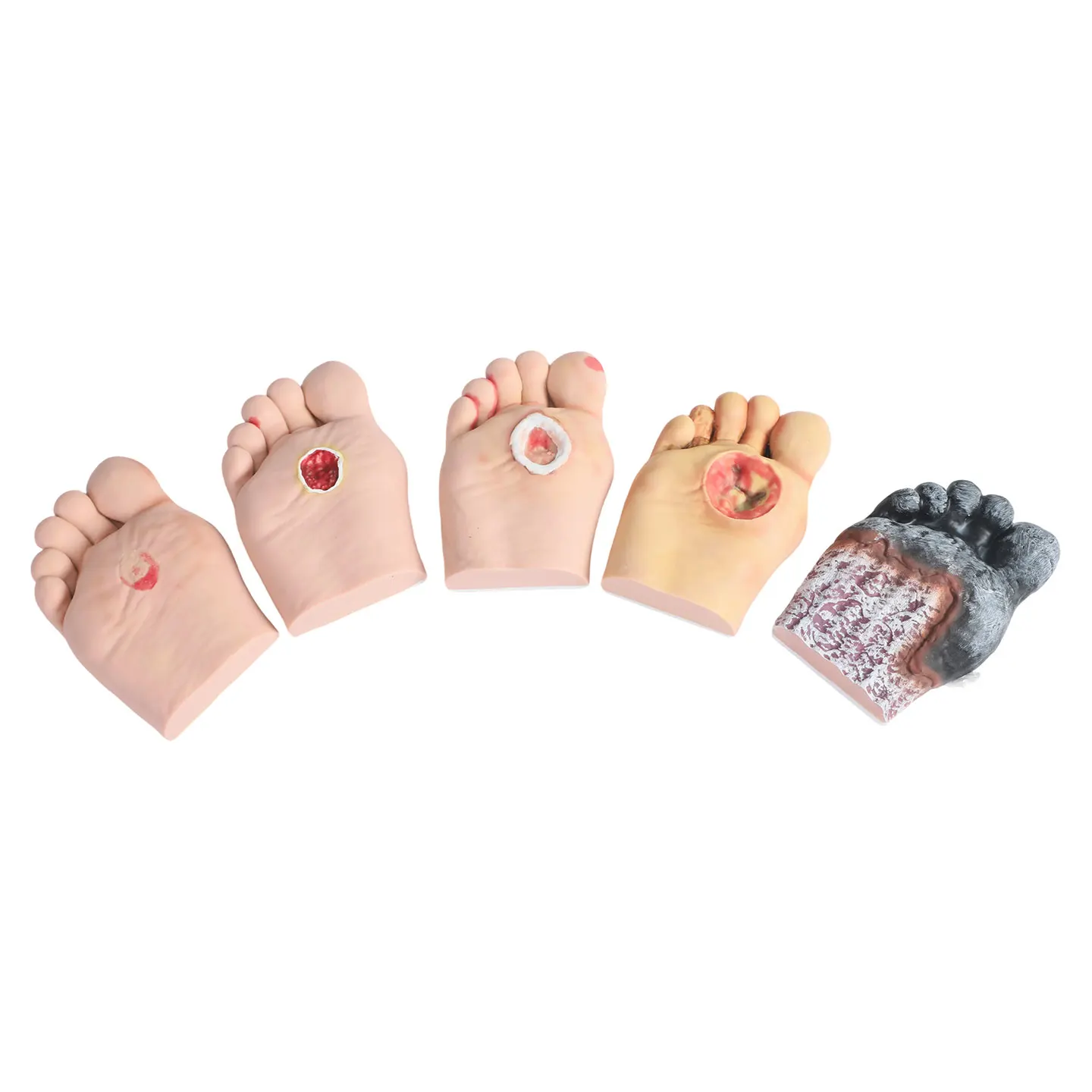 Grades 1–5 Demonstration of the Diabetic Foot Model