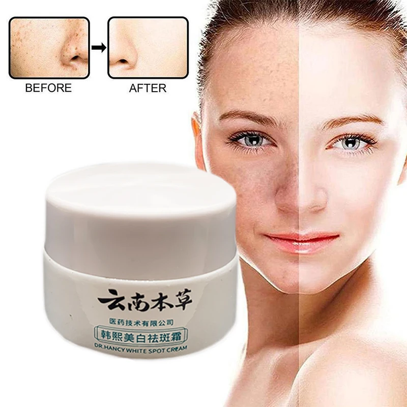 3PCS 20g Yunnan Herb Powerful Whitening Freckle Cream Remove Acne Spots Dark Spots Face Moisturizing Face Skin Care Beauty