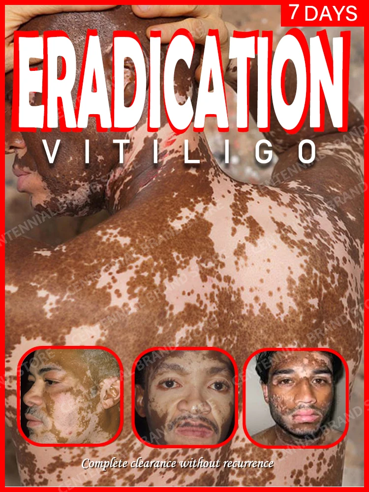 

Vitiligo ointment is effective in repairing the skin