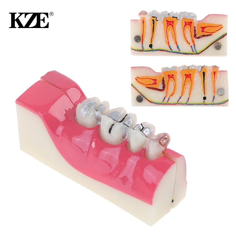 

Teeth Anatomy Study Model Molar Cross Section Decomposition Model Of Lower Right Posterior Teeth Model