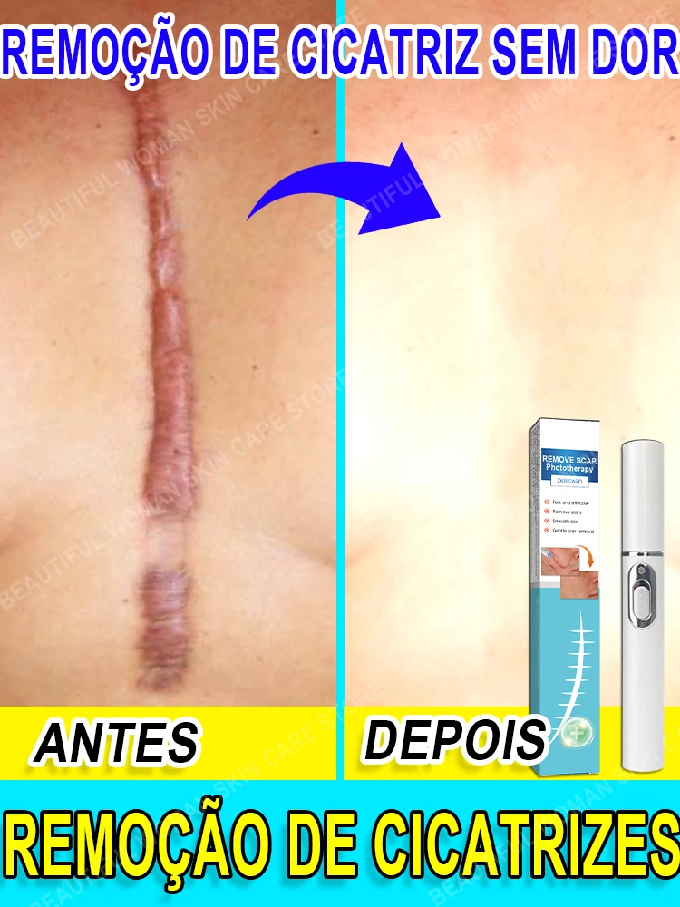 ACNE SCARS,SURGICAL PRINT,SCARS HYPERPLASIA,STRETCH MARKS,BURNS AND SCALDS,SCAR ATROPHY