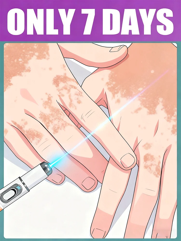 

2025 New Blue Laser care Vitiligo