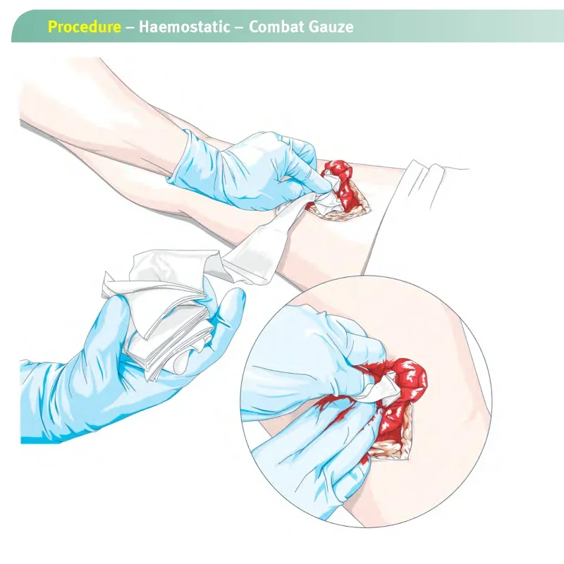 Hemostatic Kaolin Gauze Combat Emergency Trauma Z-Fold Soluble For Ifak Tactical First Aid Kit Medical Wound Dressing 1.5/3.75M view 6