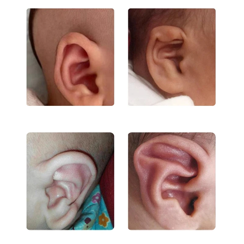 Protruding Ear Support Infant Corrector Tools Silicone Auricle Correction Patch For BabyEar Corrector Baby Auricle Valgus Corre