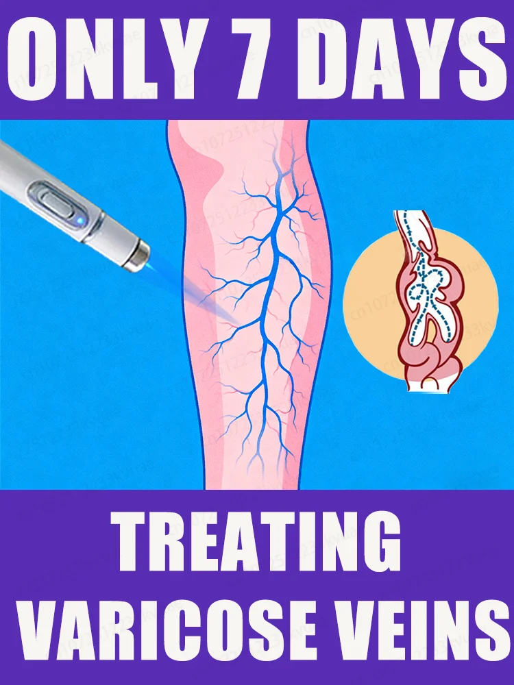 

Generation-2 Laser Says Goodbye To Spider Legs Varicose In 7 Days