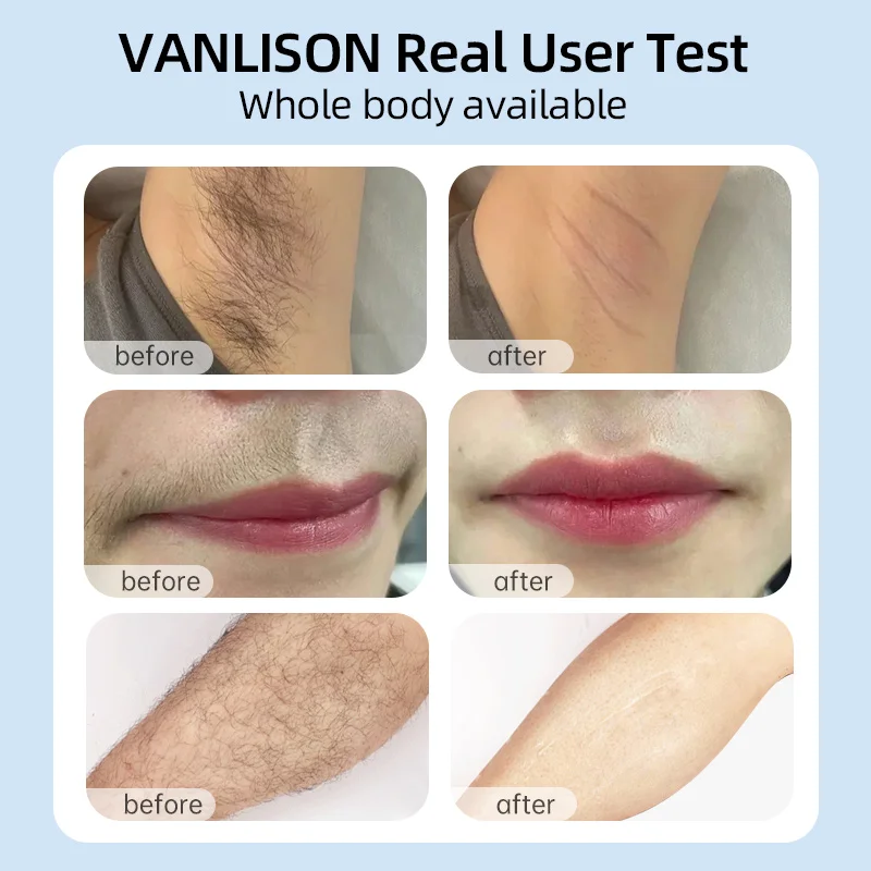 Китайские бренды, безболезненное ощущение льда, постоянное IP-лазерное устройство для удаления волос, эпилятор для лобка, всего тела, бесплатная доставка, Прямая доставка