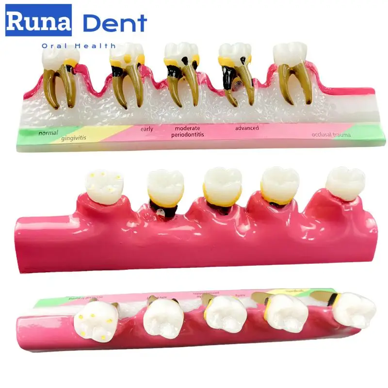 Dental Model for Stage 5 Periodontal Disease Classification Demonstration Model Teaching Tools for Medical Students