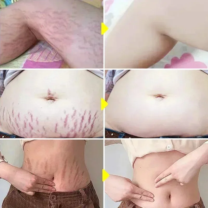 Stretch Marks ครีมกําจัดถาวร กําจัด Body Belly Stretch Marks เครื่องหมายบวม ลบรอยแตกของผิว Repair Firming Care