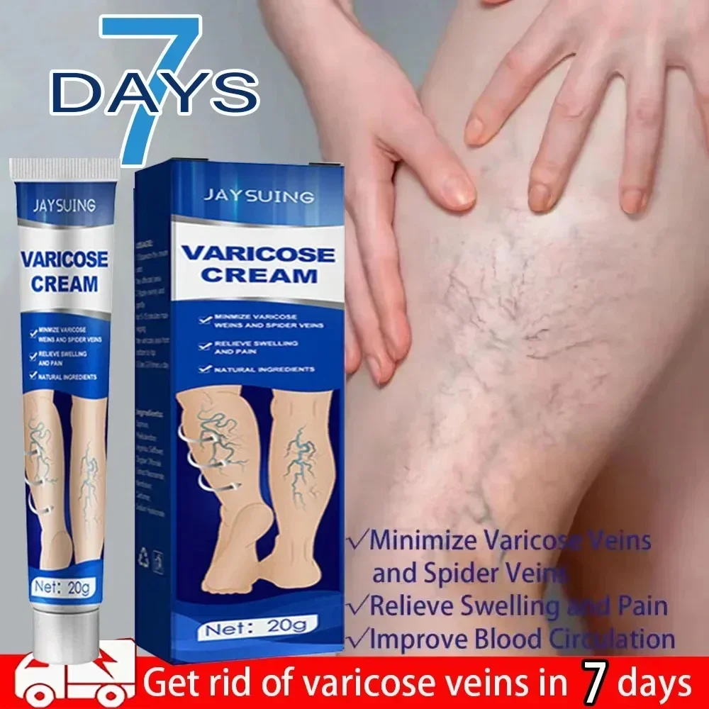 

Spider Blood Varicose Veins Effective Varicose Vein Relief Cream To Relieve Vasculitis Phlebitis Spider Pain Treatment 889966