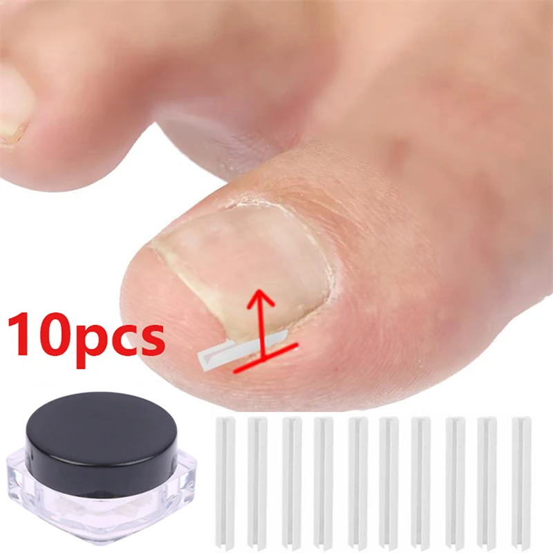 10 Stuks Plastic Ingegroeide Neus Nagelkussens Onzichtbare Nagel Correctie Stickers Paronychia Herstellen Pedicure Gereedschap Voetverzorging