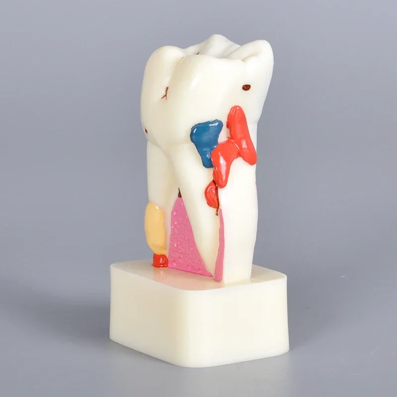 Quadruple dentals caries calculus wear pathological dentals model