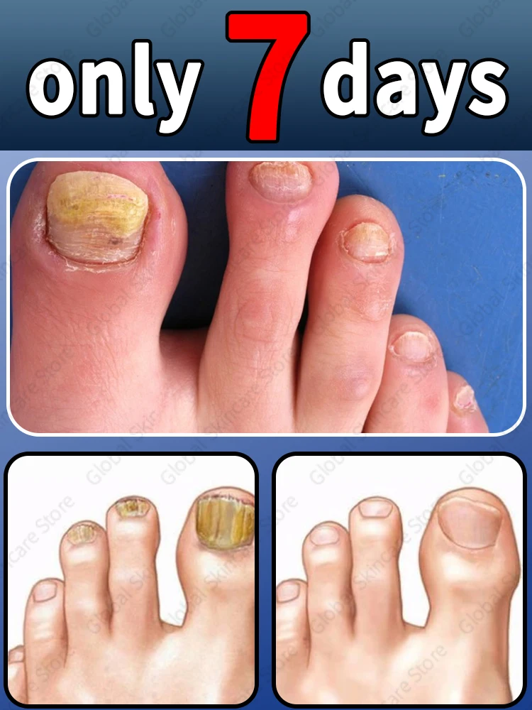 

Say goodbye to onychomycosis, no recurrence, no damage to nails.